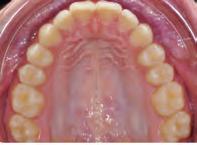 bonded on the buccal aspect of the lower first premolar and upper premolars.
