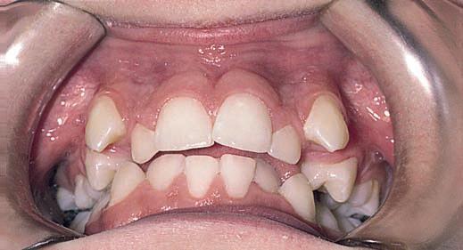 crowding ORTHODONTICS Treatment of malocclusion Assist.Lec.Kasem A.Abeas Etiology of class I malocclusion i. Skeletal factor. (usually Class I) ii. Soft tissue factor. (favourable) iii. Dental factor.