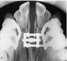 The aetiology of late lower incisor crowding is recognized as being multifactorial: o Forward growth of the mandible when maxillary growth has slowed, together with soft tissue pressures, which