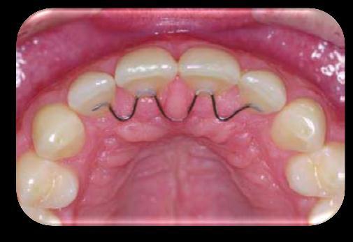 It can be corrected by using simple anterior bite planes (removable appliance) to disclude buccal segment teeth and encourage their overeruption subsequently.