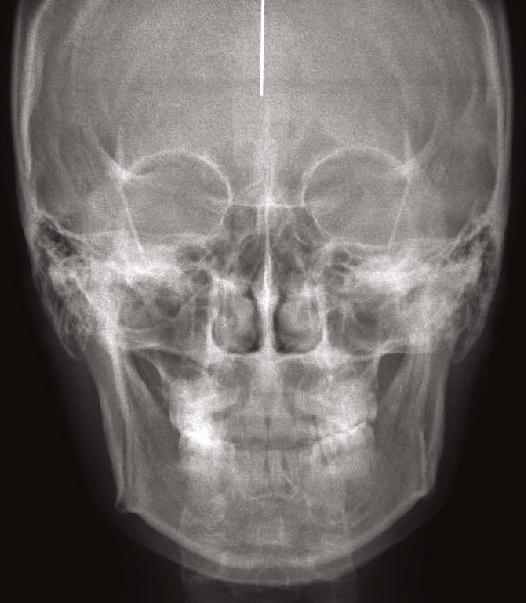 post-treatment is red. The lips are retracted slightly and the VDO is increased by posterior rotation of the mandible, but there is no net change in facial convexity.