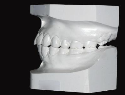 : Pre-treatment dental models (casts) U To NA mm (4 mm) 9 mm 6 mm