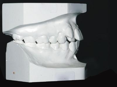 Convex (G-Sn-Pg 8 ), deceased mandibular plane angle (FMA 0 )