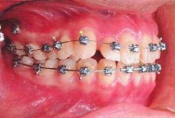 incisors.