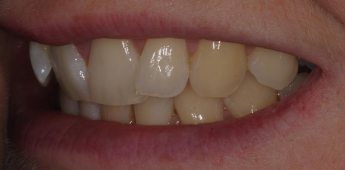 What are the benefits of ClearSmile Aligner 2.0? The ClearSmile Aligner 2.0 is the ideal treatment for mild to moderate crowding or misalignment of the eight anterior teeth.