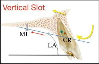 Torque control for anterior and vertical control for posterior, were established (Figure 19A-B and