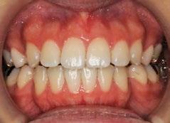 anterior teeth, there is some possibility