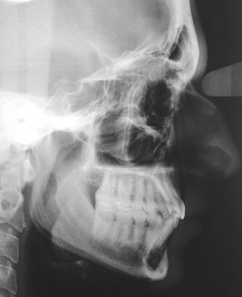 O case report Class II malocclusion associated with mandibular deficiency and maxillary and mandibular crowding: follow-up evaluation eight years after treatment completion Figure 23 - Follow-up