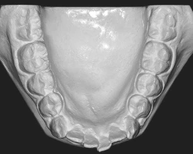 dental arches in association with distal movement and rotation of maxillary molars