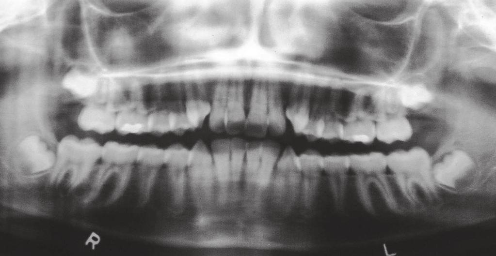intrusion of mandibular incisors.