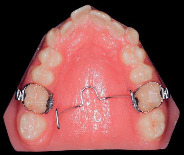 removable plate with springs on irst molars was also placed (Fig 7), and the patient received the recommendation to wear it