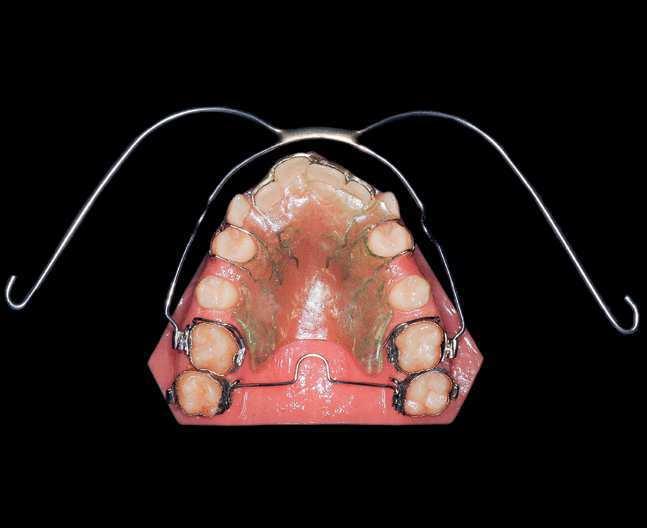 O case report Class II malocclusion associated with mandibular deficiency and maxillary and mandibular crowding: follow-up evaluation eight years after treatment completion nother transpalatal bar
