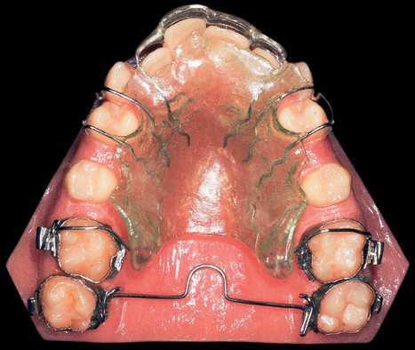 The space created between irst and second molars promoted distal movement of irst molars, under the action of the removable plate and headgear.