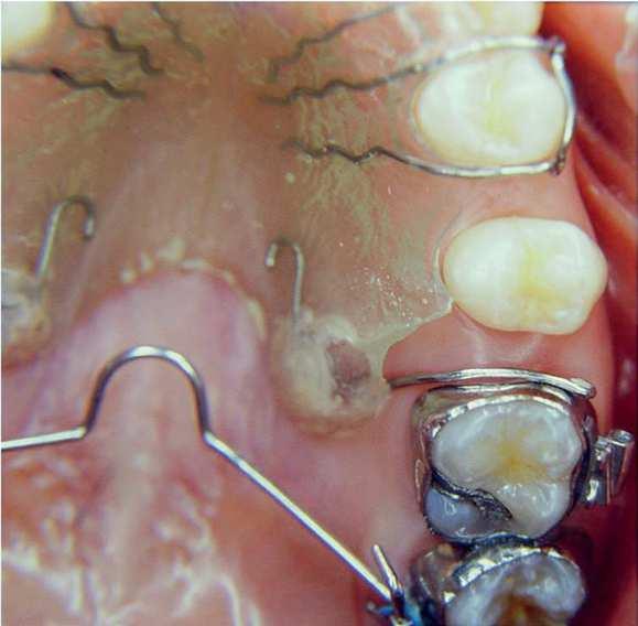 The transpalatal bar also controlled vertical growth of the maxilla. It was placed slightly away from the palate, with the Coin loop turned mesially.