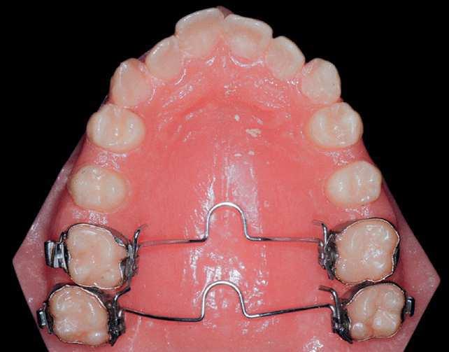 tooth position to enhance mandibular shape.