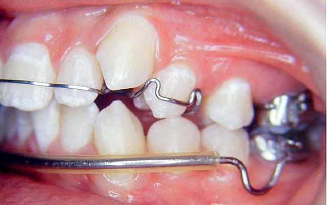 (). Figure 14 - Fixed orthodontic