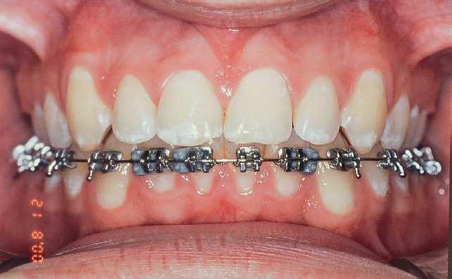 incisors (F).