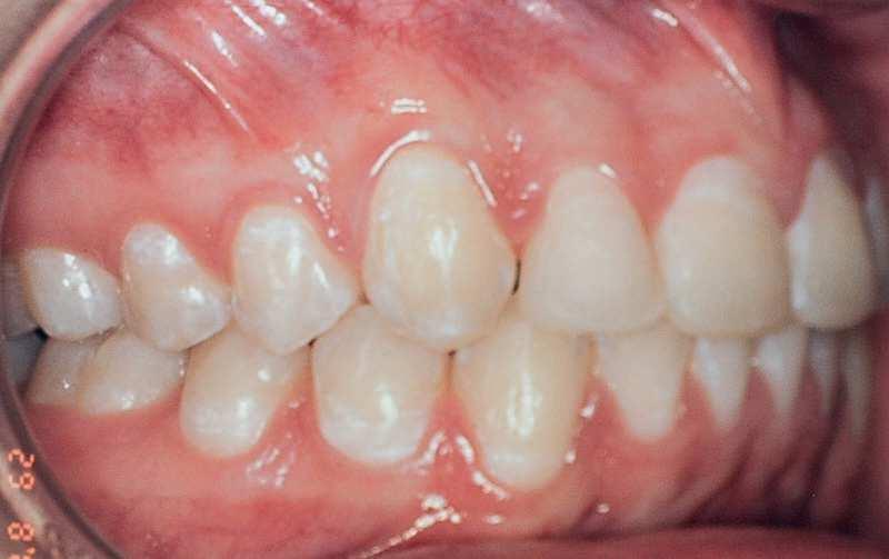 Normal occlusion was achieved between molars and between canines, and overjet and overbite were corrected, resulting in