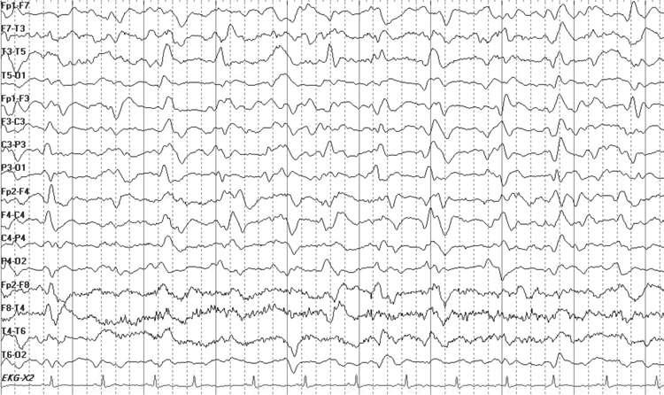 Figure 8.10: PLEDs plus. The EEG shows an example of parasagittal PLEDs plus.
