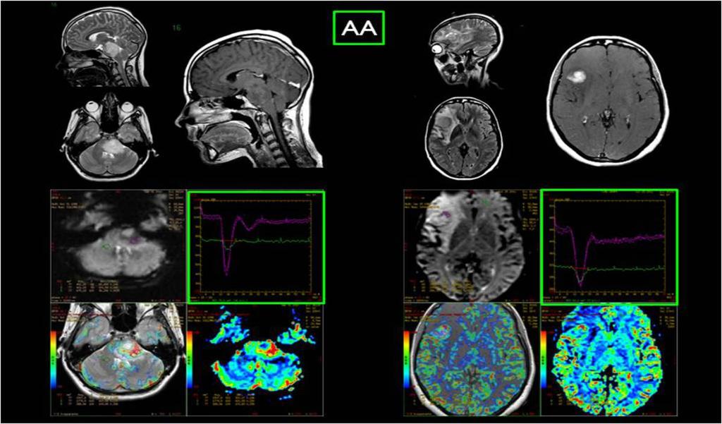 Fig. 15: Two cases of anaplastic astrocytoma, one in the pons and the other in right frontal lobe; the perfusion looks really similar, showing high