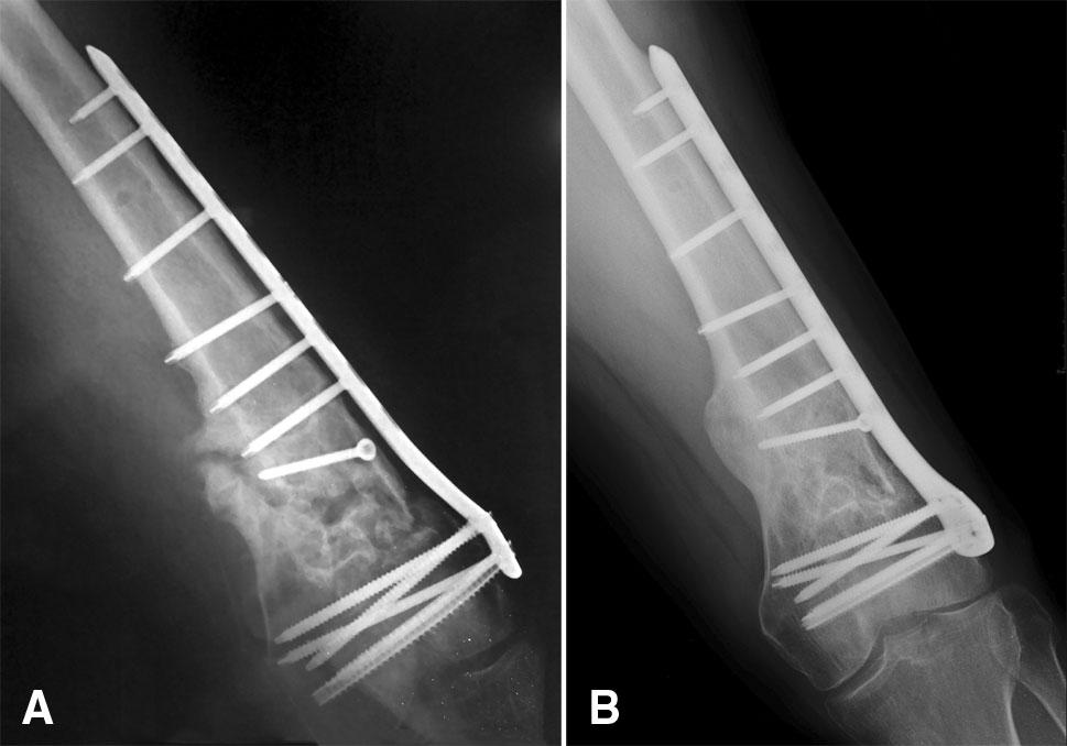3 Male 46 years. a AP view before second surgery shows a nonunion. b Radiograph at last follow-up shows fracture healing Eleven of these 66 fractures (16.