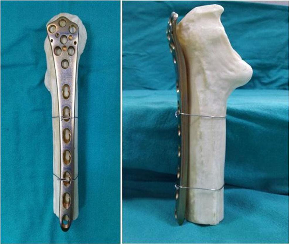 during re-osteosynthesis. Conventional implants used for proximal femoral fracture fixation, such as the dynamic hip screw (DHS), dynamic condylar screw (DCS), PFN, 950 angle blade plate etc.