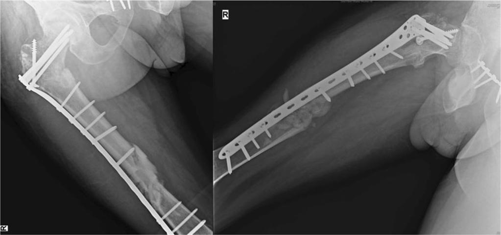 Fig. 4 Anteroposterior (AP) and lateral radiographs of case 1 showing failed proximal femoral nail (PFN) with lateral displacement of proximal screws, varus collapse and nonunion at both proximal and