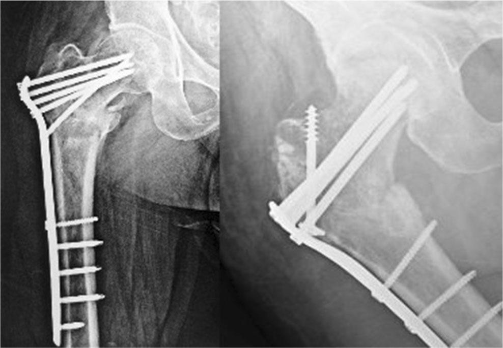Fig. 6 Broken neck screws of the proximal femoral nail (PFN) (case 3); screw cutout (BZ^ effect) (case 1) screws. The central 7.3-mm screw has an angle of 95 to the plate shaft.
