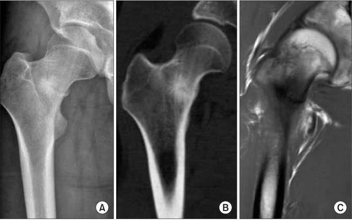 Case 2: Diagnosis Femoral Neck Stress Fracture Most common location for stress fracture in the femur Relatively rare; account for only 1-7% of all stress fractures Are high risk on the lateral aspect