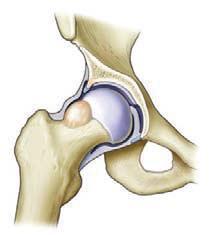 Case 3: Diagnosis Femoroacetabular Impingement (FAI) Common etiology of pain in athletes, adolescents and adults Abutment of the acetabular rim and the proximal femur Causing injury to labrum and