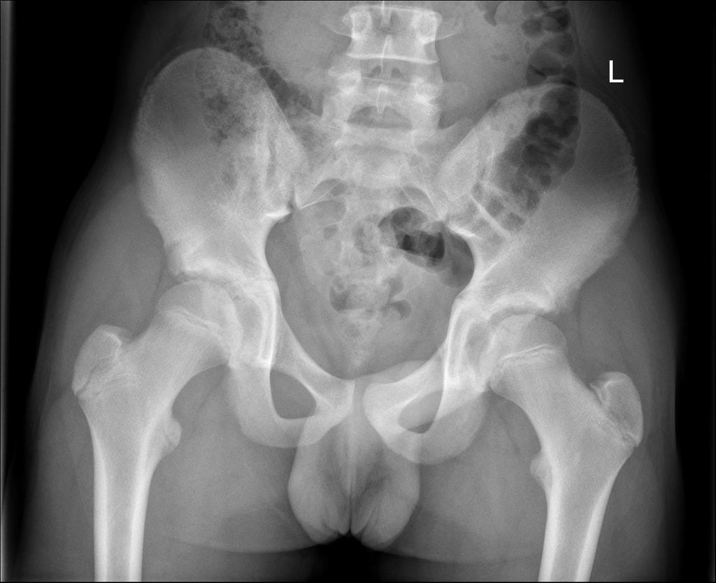 Case 4: Diagnosis Ischial apophysis avulsion Apophysis avulsion is not uncommon in adolescents prior to closure of growth plates Usually seen in 14 25yo age