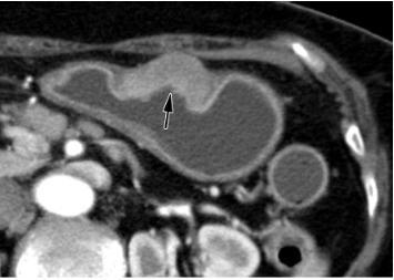 axial CT scan shows a stage T2 tumor (arrow), a localized, transmurally