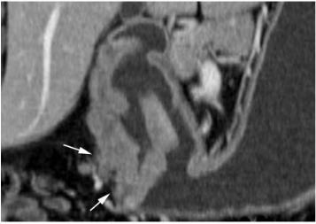 in T3 lesions, the serosal contour becomes blurred, and strand-like areas of increased attenuation may be seen extending into the