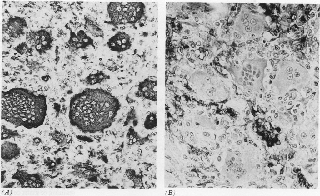 Immunophenotype of multinucleated and mononuclear cells in giant cell lesions of bone and soft tissue 401 (B) <_+ b!