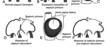 secundum Ostium Primum ASD Inferior portion of septum Failure of fusion between septum primum and endocardial cushions Cleft in MV or CAVC ASD Types Sinus Venosus ASD (10%) Incomplete absorption of