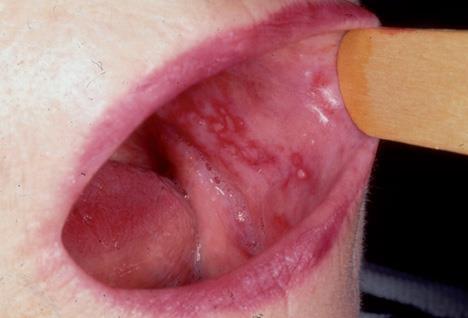 Signs and Symptms f Lichen Planus (LP) The signs and symptms f lichen planus depend n where it appears n the bdy.