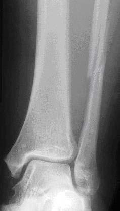 Open mortise with high fibular fracture Name?