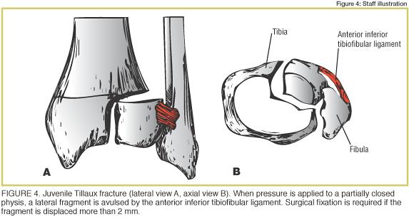 Fracture of the anterolateral tibial epiphysis Mechanism