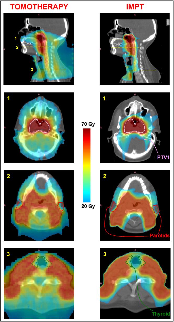 TOMO vs. IMPT IMRT v. Protons Combined rectal dose volume curves for proton therapy and intensity-modulated radiotherapy (IMRT) (n = 20 plans) L. WIDESOTT, M.