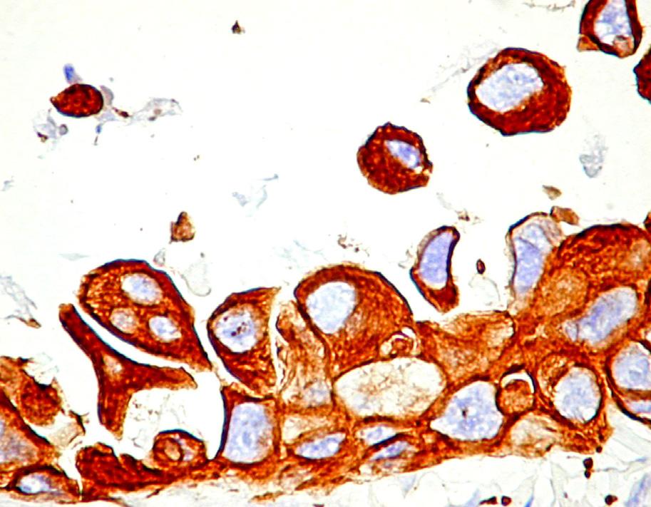 The same pattern was found in special types of carcinoma like apocrine carcinoma (b, 400) Figure 3 Membrane