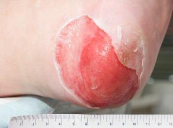 as a blister Posterior injury