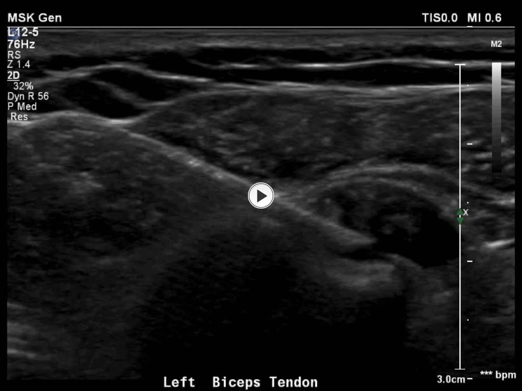 Fig. 3: Biceps tendon sheath injection Radiology Department,