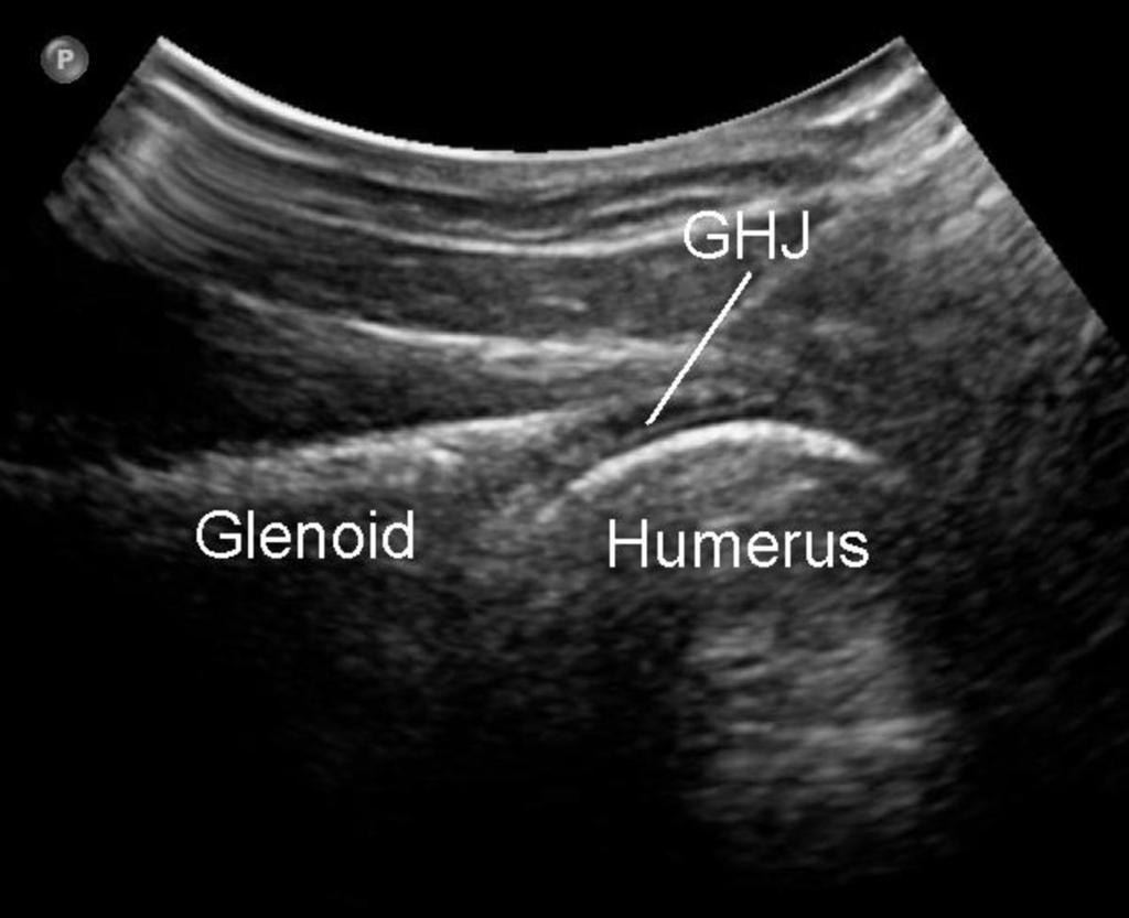 Fig. 5: Posterior view of the glenohumeral joint (GHJ) Radiology