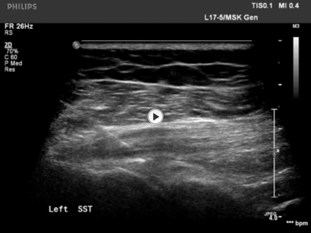 Fig. 6: Hydrodilatation of the glenohumeral joint Radiology