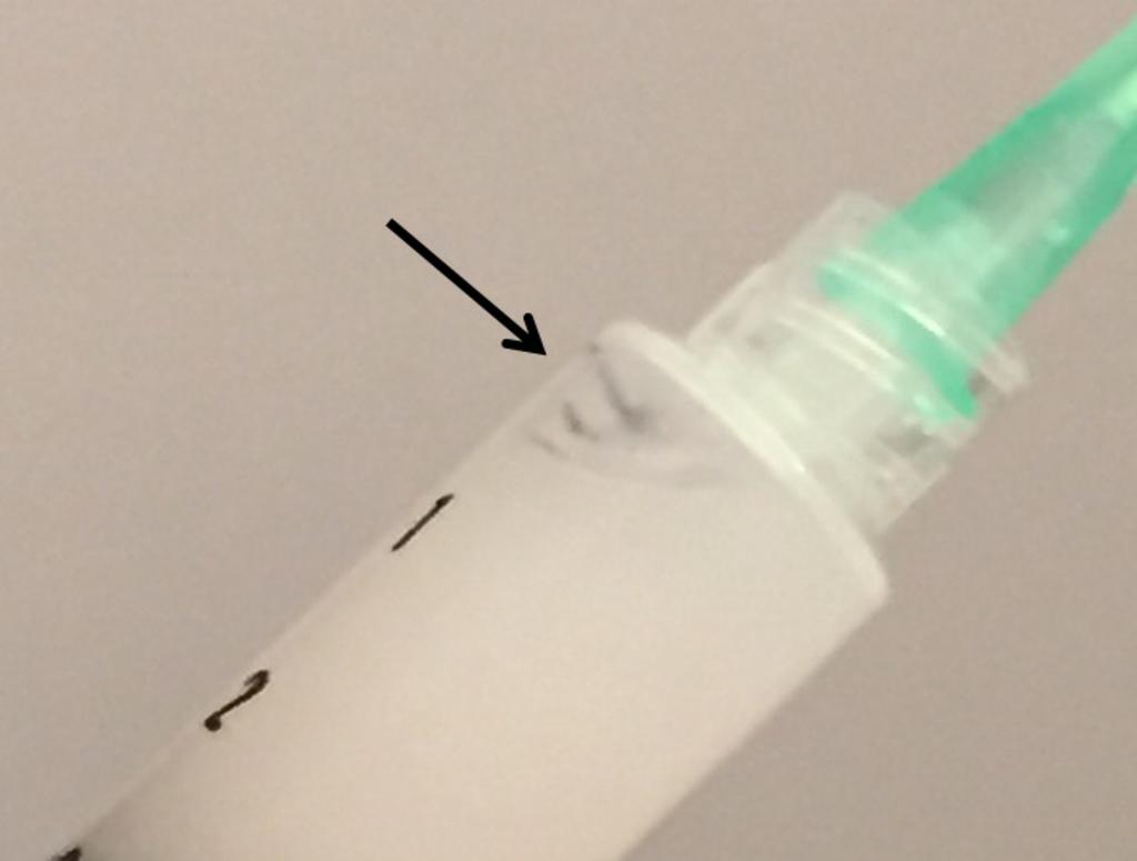 Fig. 8: Syringe containing foci of calcification (arrow) within a cloudy fluid following