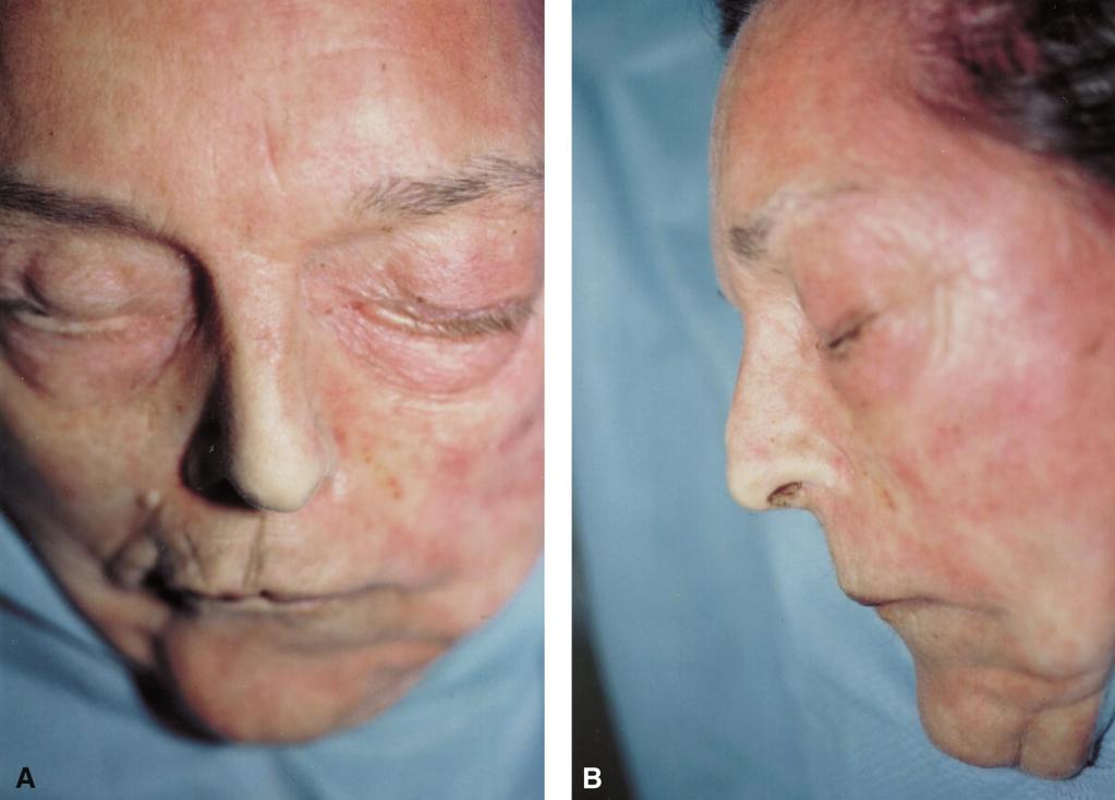 The upper buccal sulcus approach, an alternative for post-trauma rhinoplasty 219 Figure 1 Fresh cadaver before dissection, displaying deviation (1A-AP view) and dorsal hump (1B-lateral view).