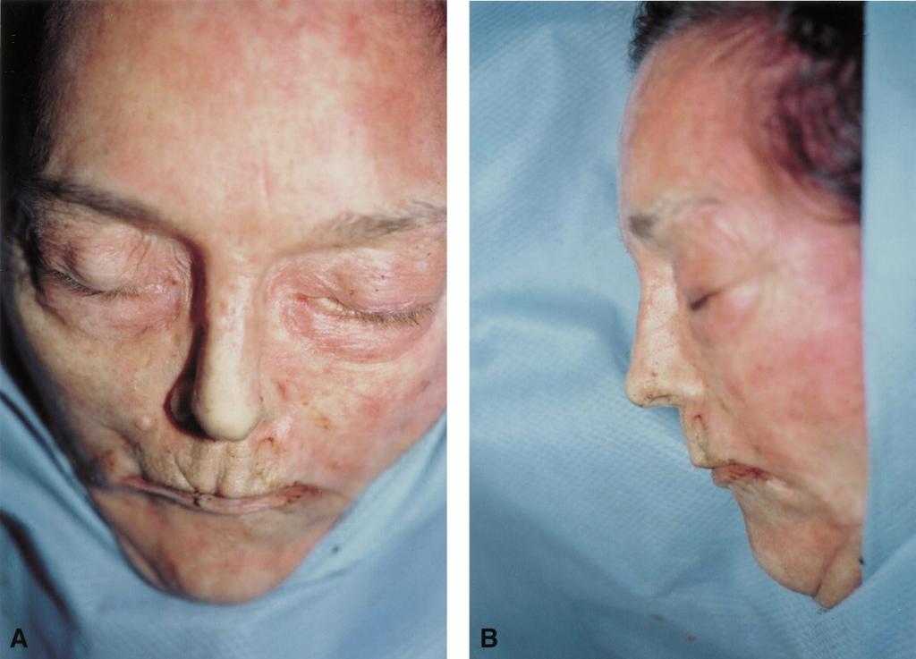 220 British Journal of Plastic Surgery Figure 3 AP (3A) and lateral (3B) views of the same