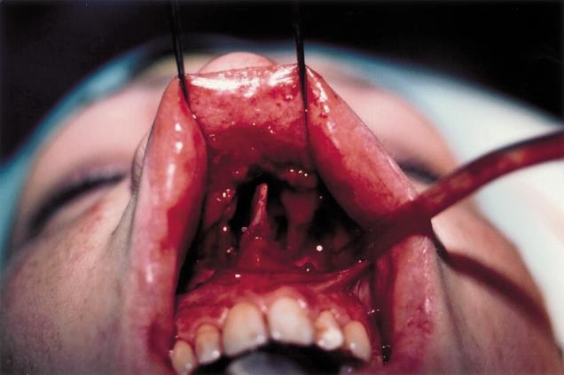 The upper buccal sulcus approach, an alternative for post-trauma rhinoplasty 221 Figure 5 Case one: anterior view. Upper buccal sulcus approach, showing septal resection.