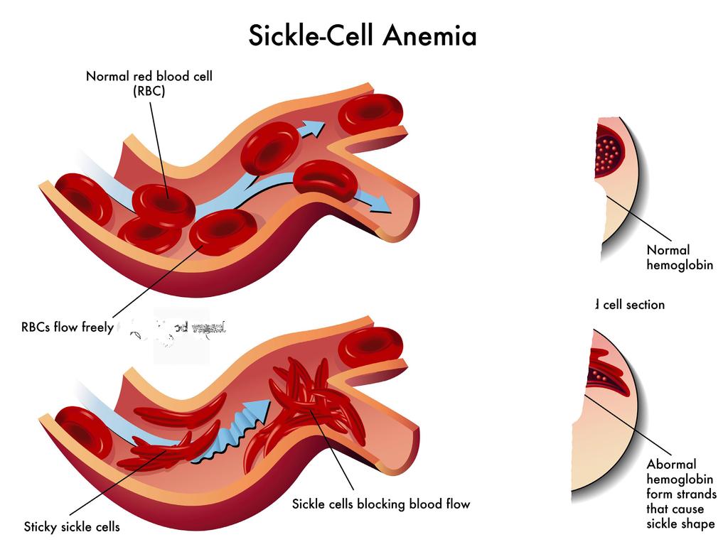 Pain People with sickle cell disease will sometimes have pain. This may be called a pain crisis.