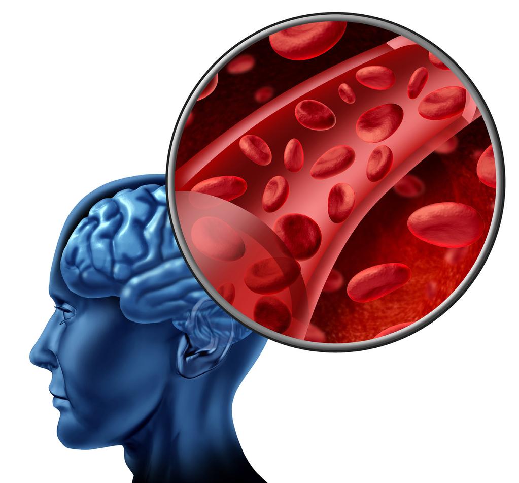 Stroke Sometimes sickle cells can get stuck in the brain. This can cause a stroke. This picture shows how blood is supposed to move through the brain.